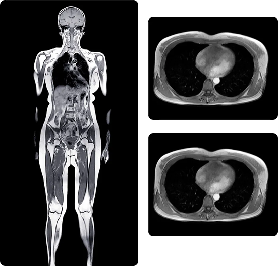 Whole Body MRI